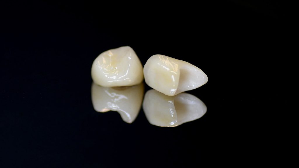 Cyrkonowe licowane porcelaną korony zębowe - Ruda Śląska