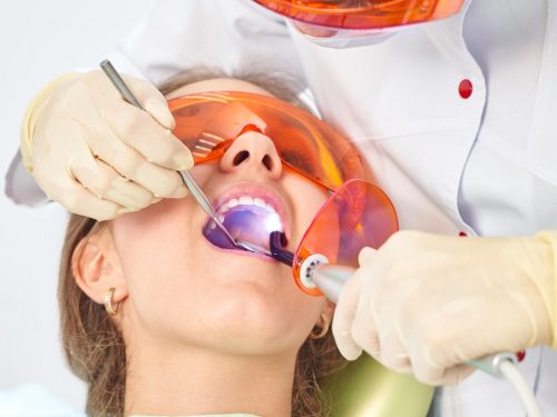 Wypełnienie zęba – jak ważne jest dla trwałości zabiegu
