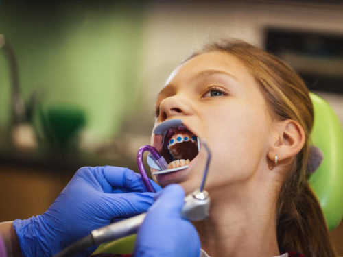 Aparat ortodontyczny dla dzieci — jaki będzie najlepszy i od czego zależy wybór
