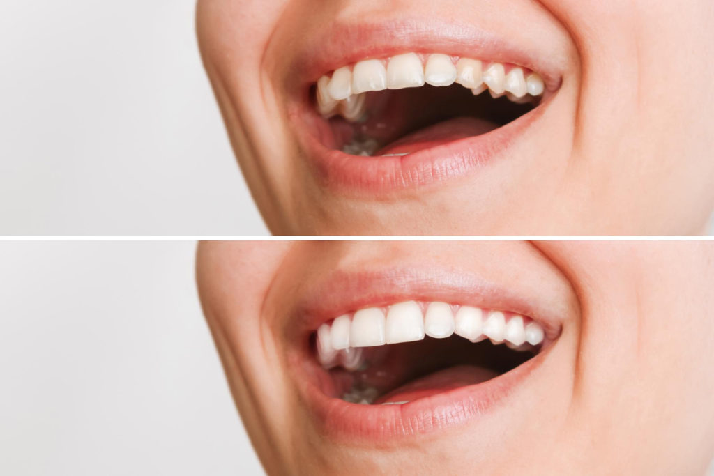 Efekt przed i po założeniu licówek. Licówki na zęby — jakie są ich zalety