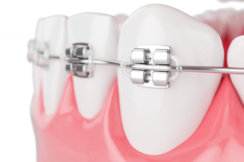 Aparat ortodontyczny - zbliżenie. Co jeść z aparatem ortodontycznym