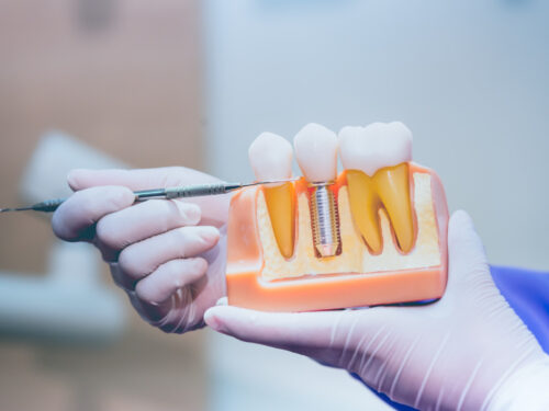 Czy implanty zębowe są dla każdego?