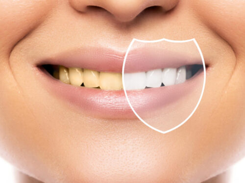 5 mitów o wybielaniu zębów, które musisz znać