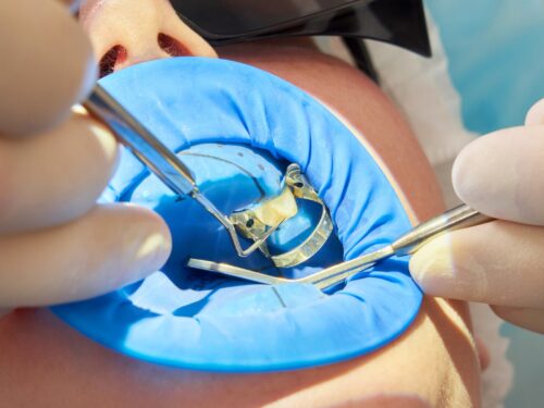 Wypełnianie kompozytowe, które naprawdę znika