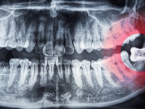 Ząb mądrości – objawy, które zwiastują kłopoty