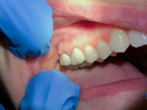 Ropa w zębie – plan działania na 24 h