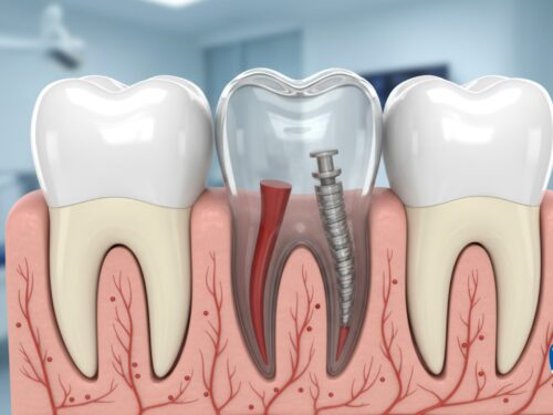 Wkład koronowo-korzeniowy – ratunek po endodoncji