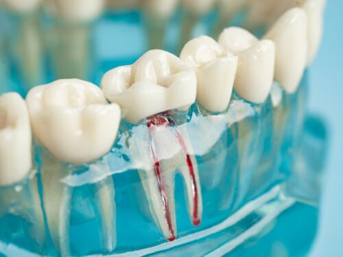 Leczenie kanałowe etapy – przewodnik pacjenta