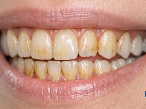 Osad na zębach – kawa, herbata, papierosy